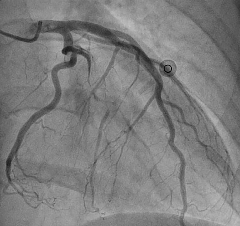 Spontaneous Coronary Artery Dissection